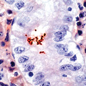        / Helicobacter pylori.