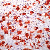     ALK/p80 / ALK  (Anaplastic Lymphoma Kinase) / p80 Ab-1