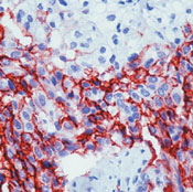      / Mesothelioma Ab-1