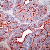        / Thyroid Cancer Marker  