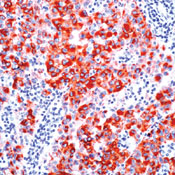      (gp100) / Melanoma (gp100) Ab-1