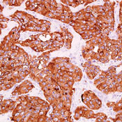      / Synaptophysin (Neuroendocrine Marker)  